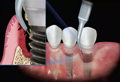 Advantages of 980nm Laser in the Treatment of Implants