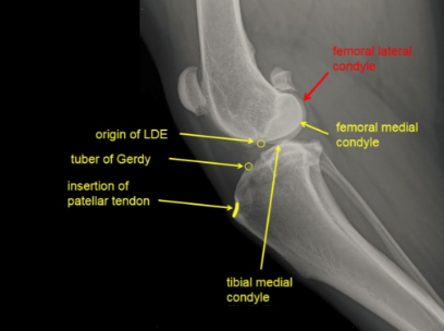 tibial plateau level orthosis, laser physical therapy