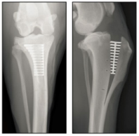 tibial plateau level orthosis, laser physical therapy