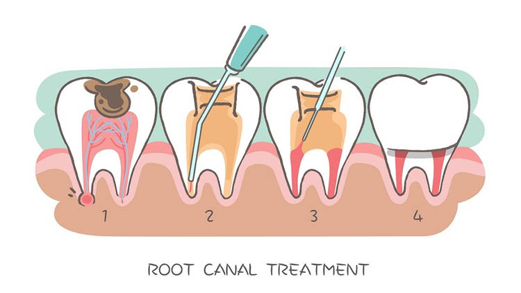 Application of Laser in Root Canal Treatment