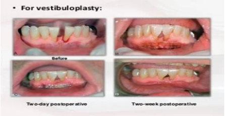 Diode Laser for Vestibuloplasty in Dental Surgery