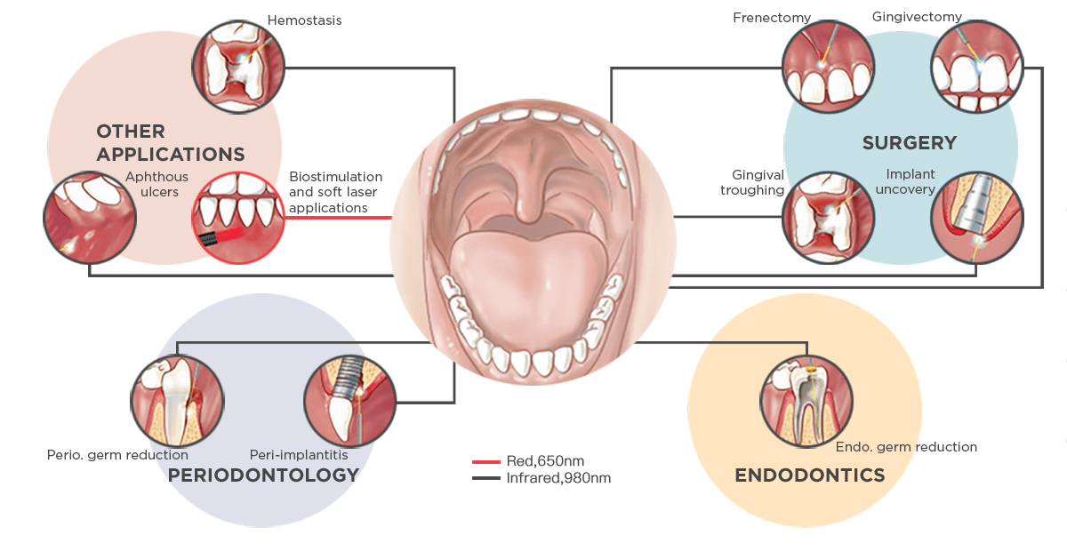 LunDent Soft Tissue Dentistry Laser Assist with Multiple Clinical Procedures