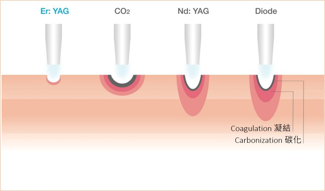 Different Applications of Different Laser in Oral Treatment