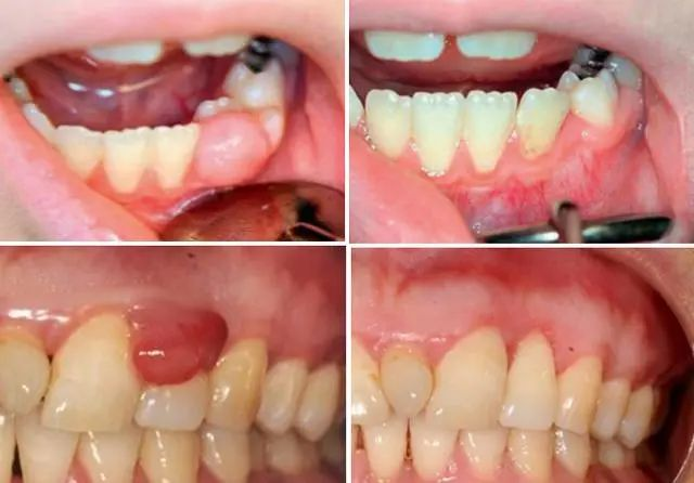 Advantages of Laser Treatment of Periodontal Disease