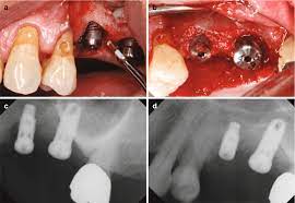 The Diode Laser as an Adjunct to Implant Treatment