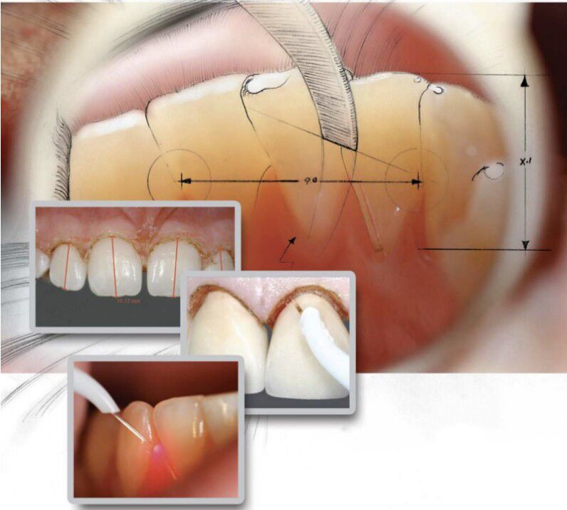 Application of Laser in the Field of Stomatology