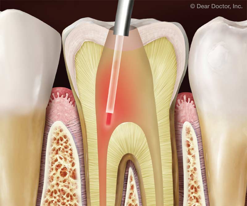 The Use of Lasers in Disinfection and Cleanliness of Root Canals