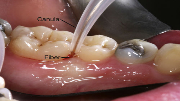 Diode Laser Treatment for Periodontal Sterilization