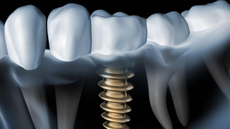 Laser Therapy for Peri-Implantitis