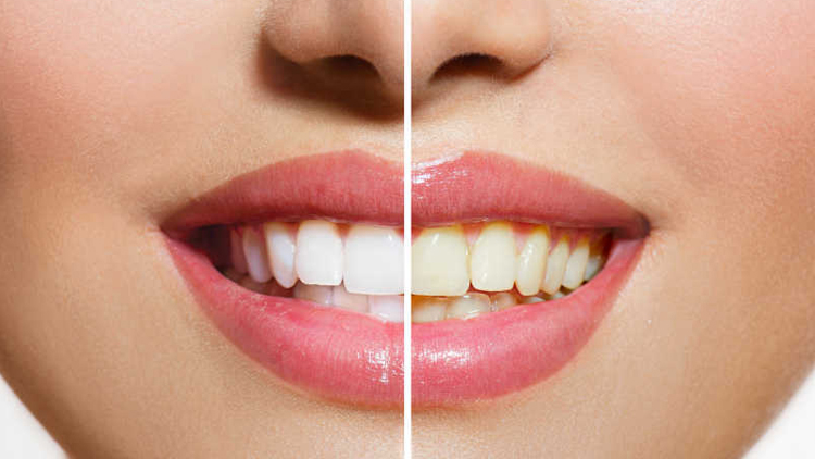 Diode Laser with 980nm Wavelength for Tooth Whitening 