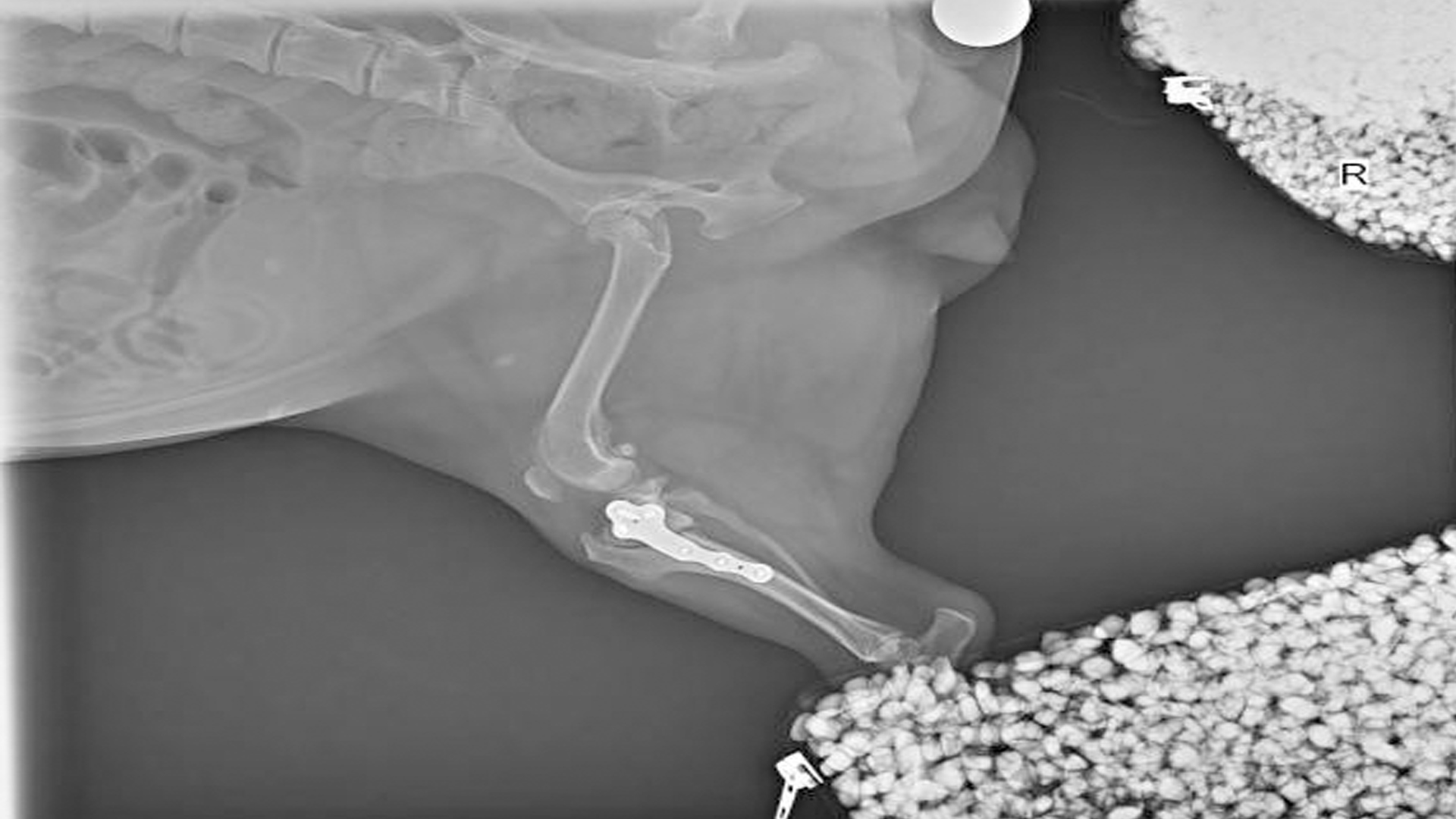 A Case of Postoperative Interventional Laser Therapy During Anterior Cruciate Ligament Rupture (2/2)